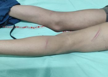 निजी स्कूल के टीचरो ने छात्र पर लात घुसो के बाद बरसाए डंडे,हालत गंभीर।.